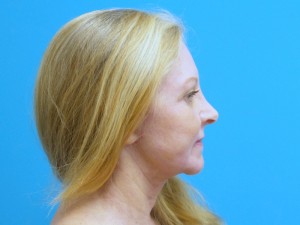 Facelift Before and After Pictures Fort Lauderdale, FL