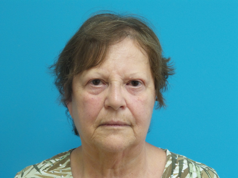 Face-Lift-65 Facelift Before and After Pictures Fort Lauderdale, FL