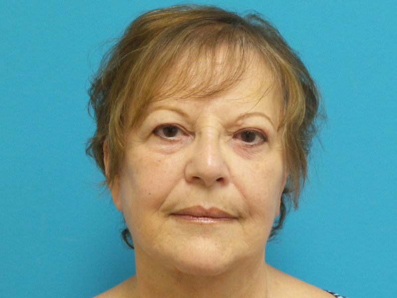 Face-Lift-66 Facelift Before and After Pictures Fort Lauderdale, FL
