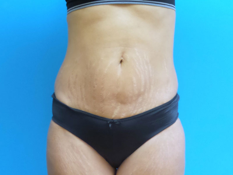 Mini Tummy Tuck Before & After Photos Fort Lauderdale, Coral Springs