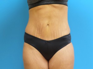 Mini Tummy Tuck Before and After Pictures Fort Lauderdale, FL