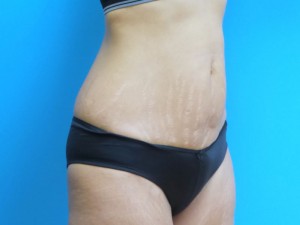 Mini Tummy Tuck Before and After Pictures Fort Lauderdale, FL