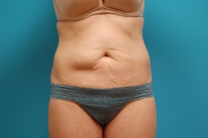 Tummy Tuck Before and After Pictures Fort Lauderdale, FL