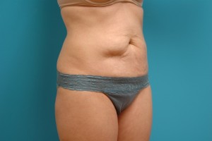 Tummy Tuck Before and After Pictures Fort Lauderdale, FL