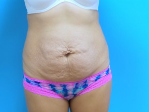 Tummy Tuck Before and After Pictures Fort Lauderdale, FL