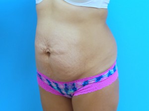 Tummy Tuck Before and After Pictures Fort Lauderdale, FL