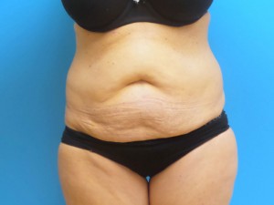 Tummy Tuck Before and After Pictures Fort Lauderdale, FL