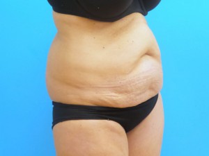 Tummy Tuck Before and After Pictures Fort Lauderdale, FL