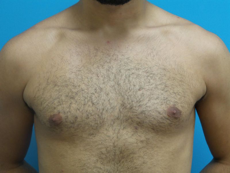 Gynecomastia Before and After Pictures Fort Lauderdale, FL