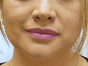 Lip Augmentation Before and After Pictures Fort Lauderdale, FL