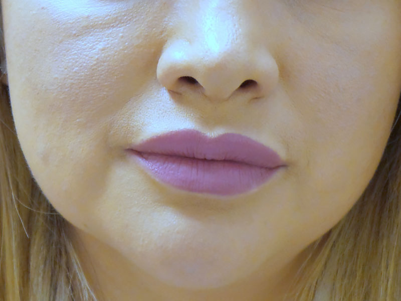 lip-augmentation-14 Lip Augmentation Before and After Pictures Fort Lauderdale, FL