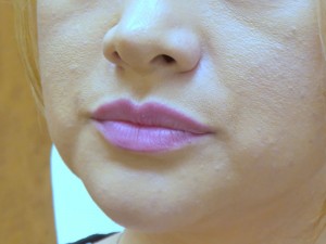 Lip Augmentation Before and After Pictures Fort Lauderdale, FL