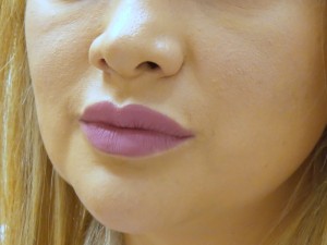 Lip Augmentation Before and After Pictures Fort Lauderdale, FL