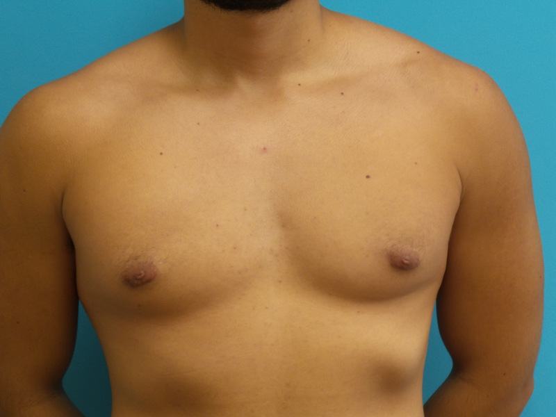 Gynecomastia Before and After Pictures Fort Lauderdale, FL