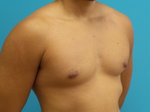 Gynecomastia Before and After Pictures Fort Lauderdale, FL