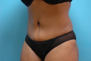 Tummy Tuck Before and After Pictures Fort Lauderdale, FL