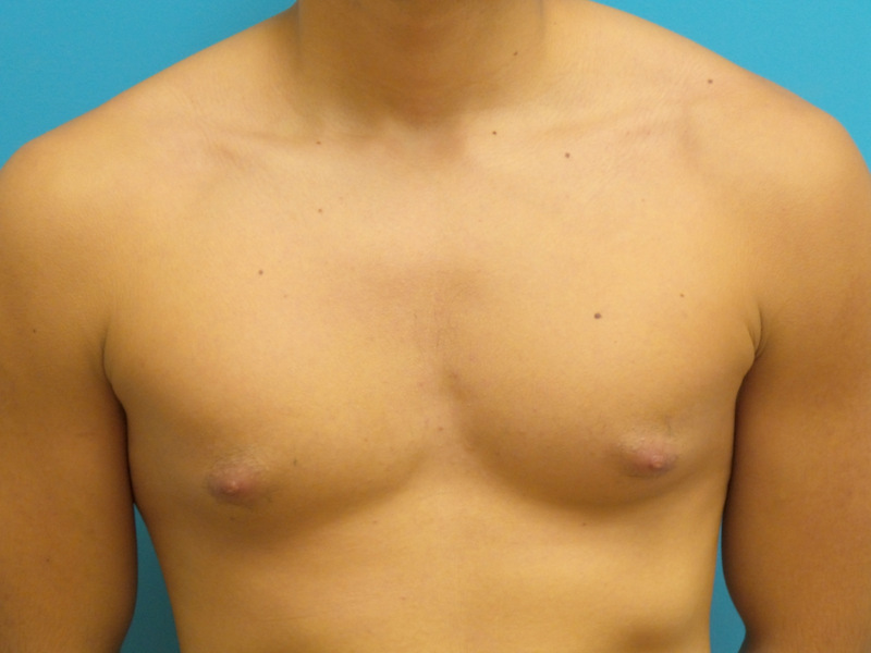 Gynecomastia Before and After Pictures Fort Lauderdale, FL