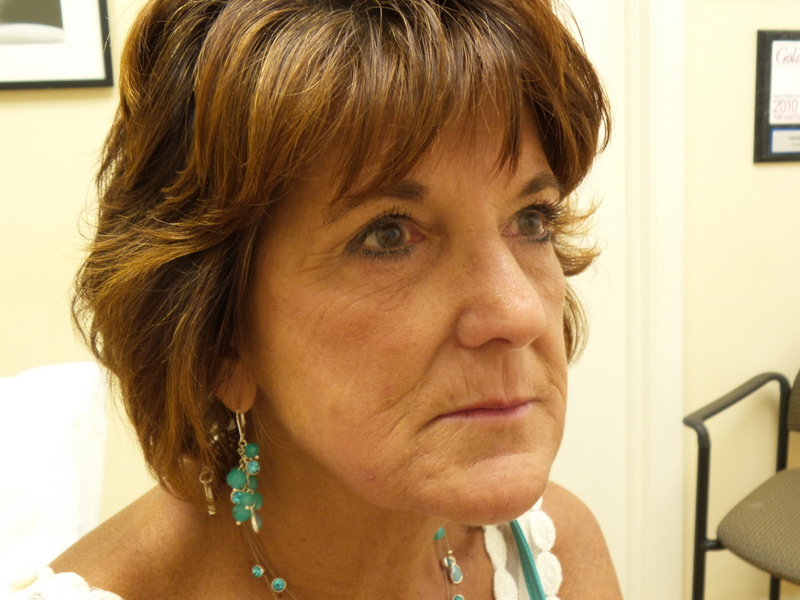 Before 1 Fillers Before and After Pictures Fort Lauderdale, FL