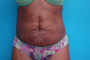 Tummy Tuck Before and After Pictures Fort Lauderdale, FL