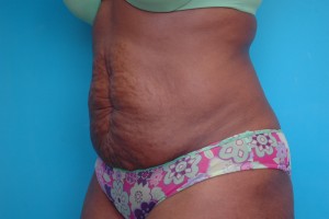 Tummy Tuck Before and After Pictures Fort Lauderdale, FL