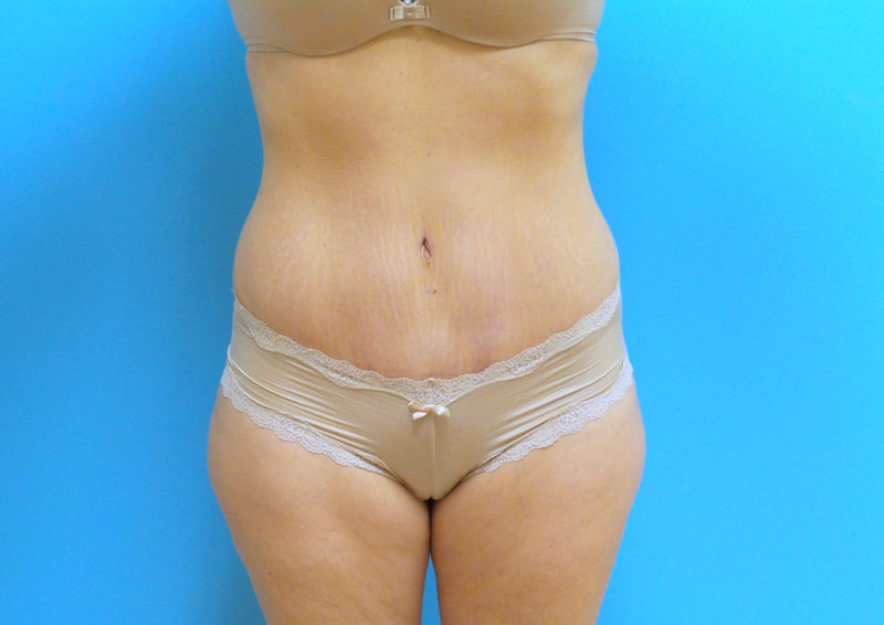 Tummy Tuck Before and After Pictures Fort Lauderdale, FL