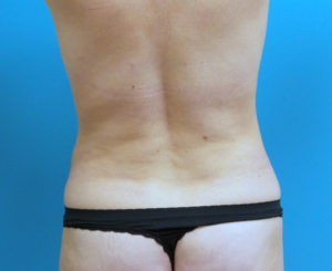 Tummy Tuck Before and After Pictures Fort Lauderdale, FL