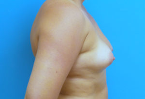 Breast Augmentation Before and After Pictures Fort Lauderdale, FL