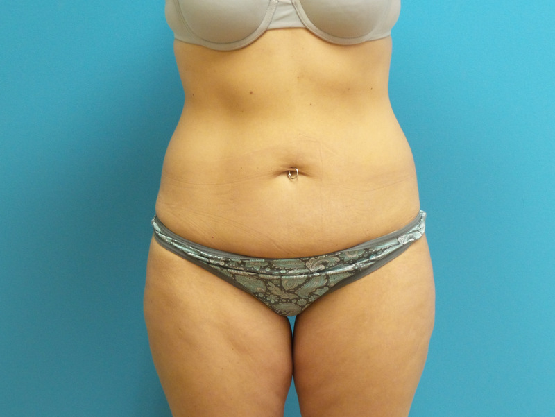 Lower Body Lift Before and After Pictures Fort Lauderdale, FL