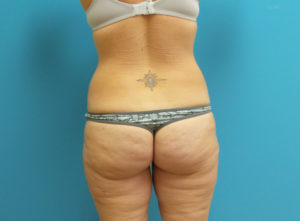 Lower Body Lift Before and After Pictures Fort Lauderdale, FL