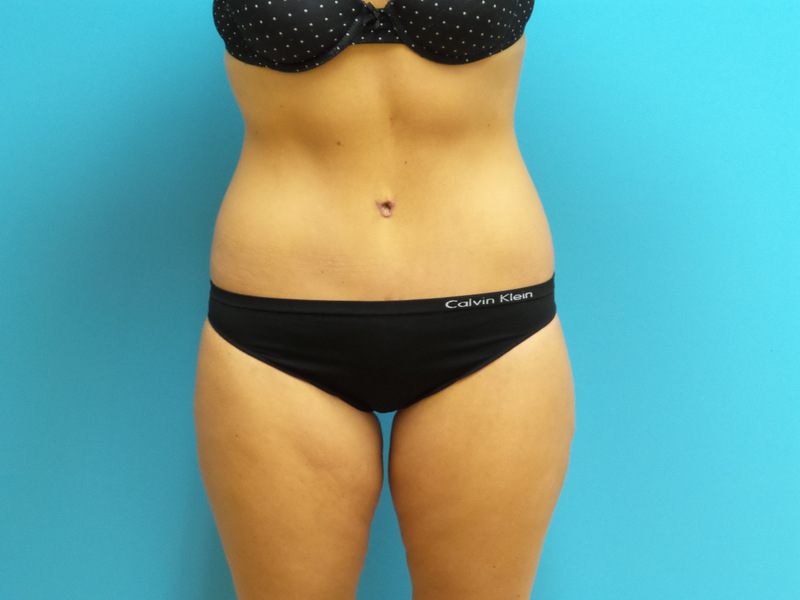 Lower Body Lift Before and After Pictures Fort Lauderdale, FL