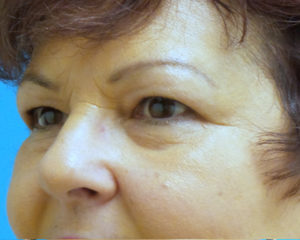 Blepharoplasty Before and After Pictures Fort Lauderdale, FL