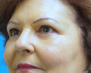 Blepharoplasty Before and After Pictures Fort Lauderdale, FL