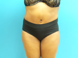 Tummy Tuck Before and After Pictures Fort Lauderdale, FL