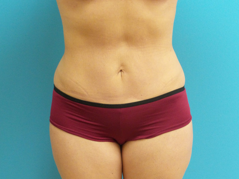 Liposuction Before and After Pictures Fort Lauderdale, FL