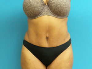 Tummy Tuck Before and After Pictures Fort Lauderdale, FL