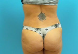 Tummy Tuck Before and After Pictures Fort Lauderdale, FL