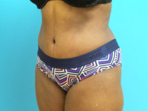 Tummy Tuck Before and After Pictures Fort Lauderdale, FL