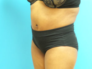 Tummy Tuck Before and After Pictures Fort Lauderdale, FL