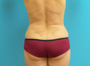 Liposuction Before and After Pictures Fort Lauderdale, FL