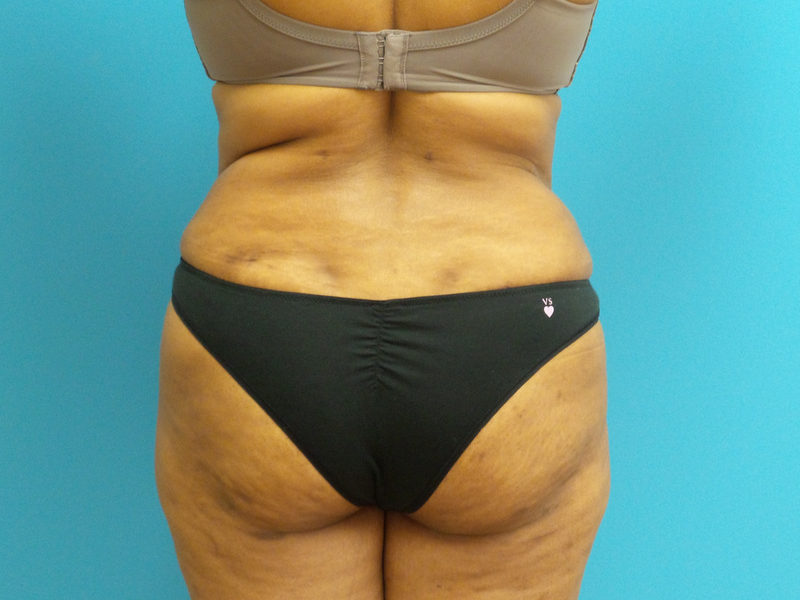 Tummy Tuck Before and After Pictures Fort Lauderdale, FL