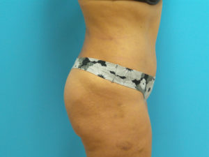 Tummy Tuck Before and After Pictures Fort Lauderdale, FL