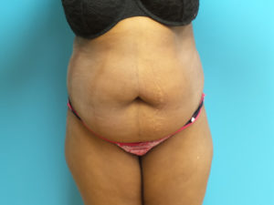 Tummy Tuck Before and After Pictures Fort Lauderdale, FL