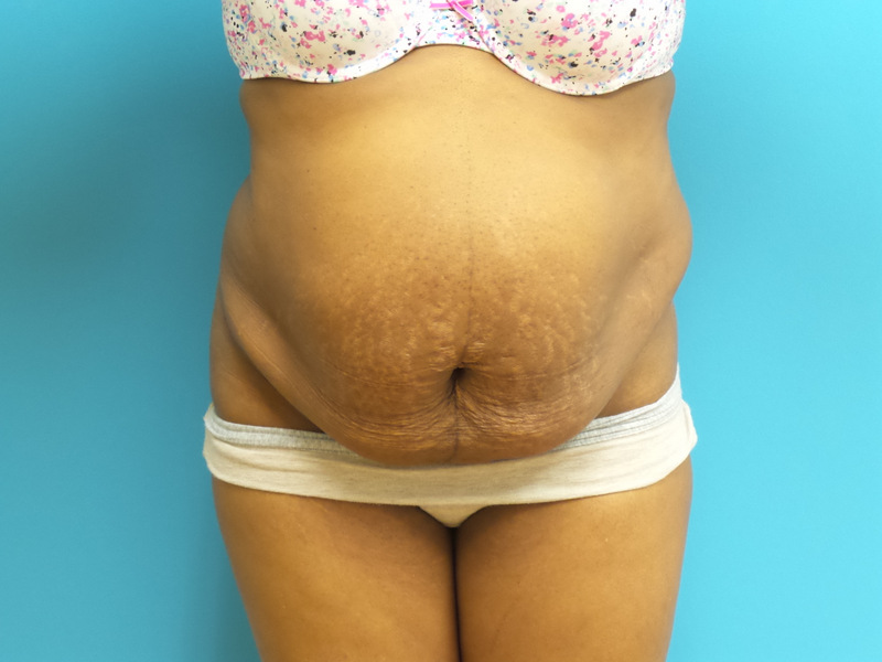 Tummy Tuck Before and After Pictures Fort Lauderdale, FL