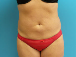 Liposuction Before and After Pictures Fort Lauderdale, FL