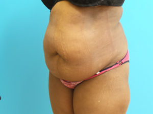 Tummy Tuck Before and After Pictures Fort Lauderdale, FL