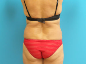 Liposuction Before and After Pictures Fort Lauderdale, FL