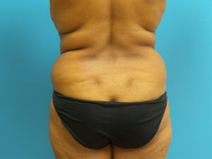 Tummy Tuck Before and After Pictures Fort Lauderdale, FL