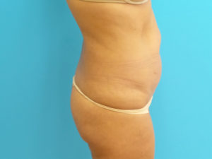 Tummy Tuck Before and After Pictures Fort Lauderdale, FL