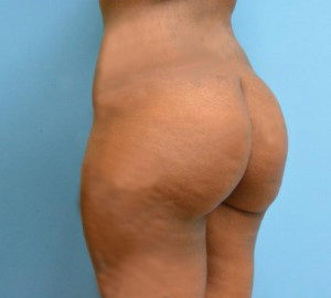 Brazilian Butt Lift Before and After Pictures Fort Lauderdale, FL