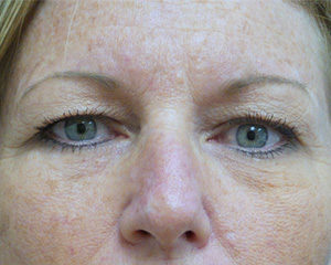 Blepharoplasty Before and After Pictures Fort Lauderdale, FL